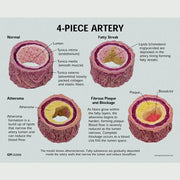 Artery sections (4) (oversized) - with Handle