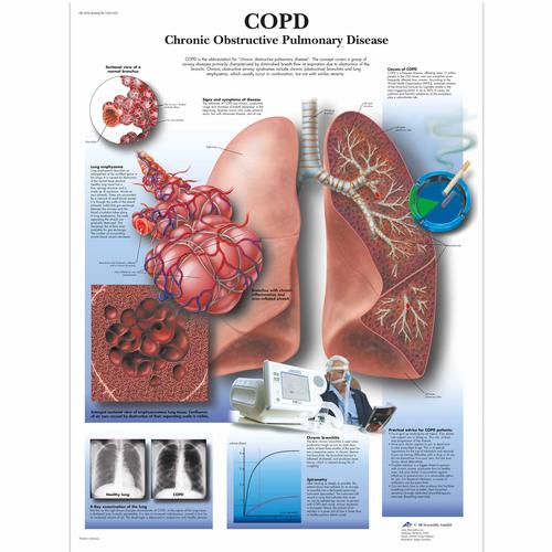 COPD, papír falikép (angol nyelvű)