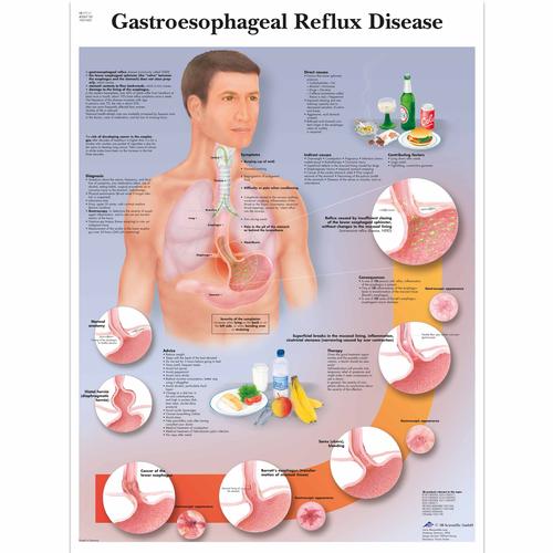 Gastroesophagealis reflux, laminált falikép (angol nyelvű)